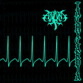 Tachycardia